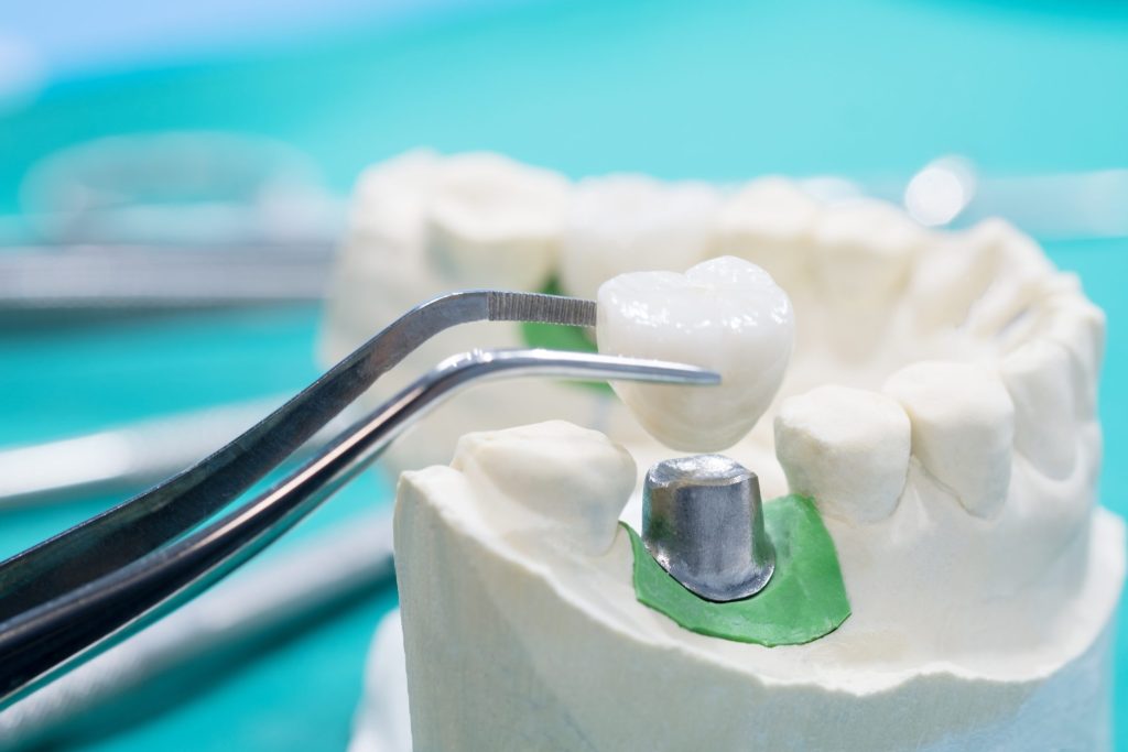 How Dental Crowns Can Improve Your Oral Health