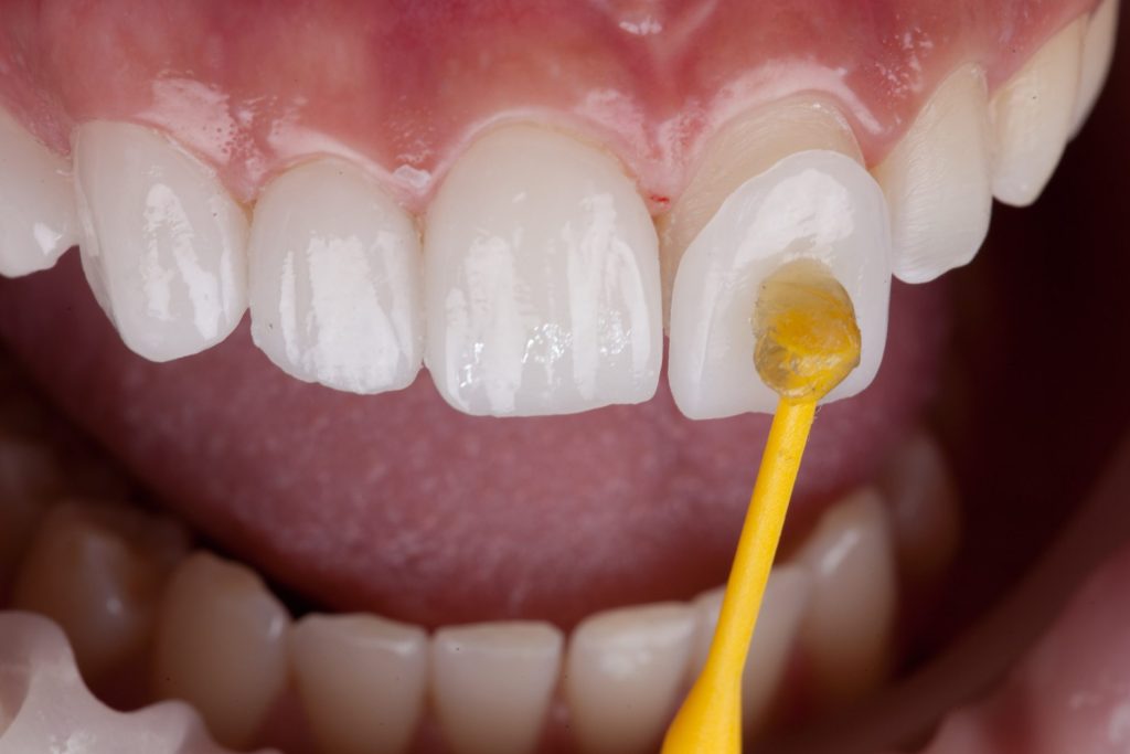 Is Dental Bonding Better Than Veneers?
