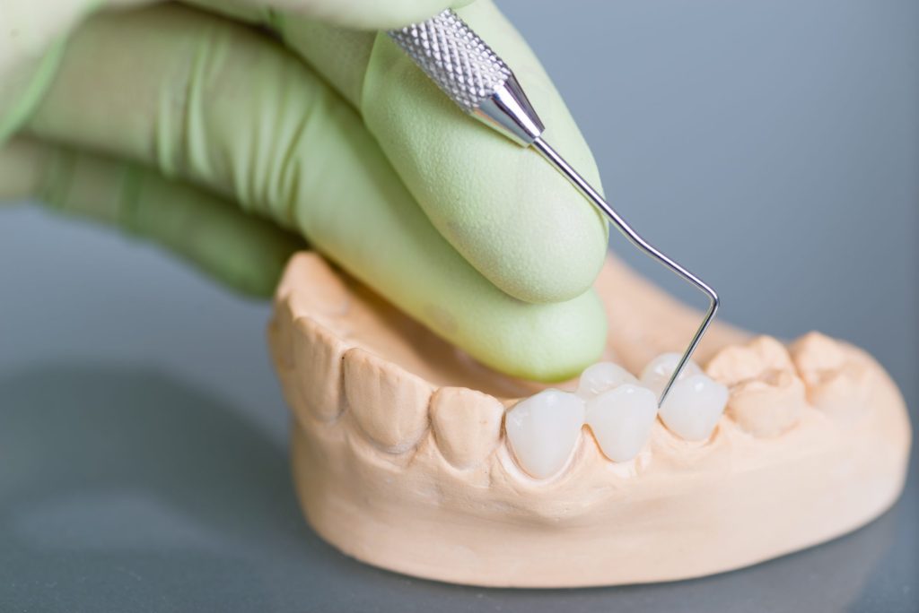 Types, Advantages, and Disadvantages of Dental Bridges